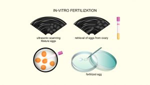 in vitro fertilization (IVF)