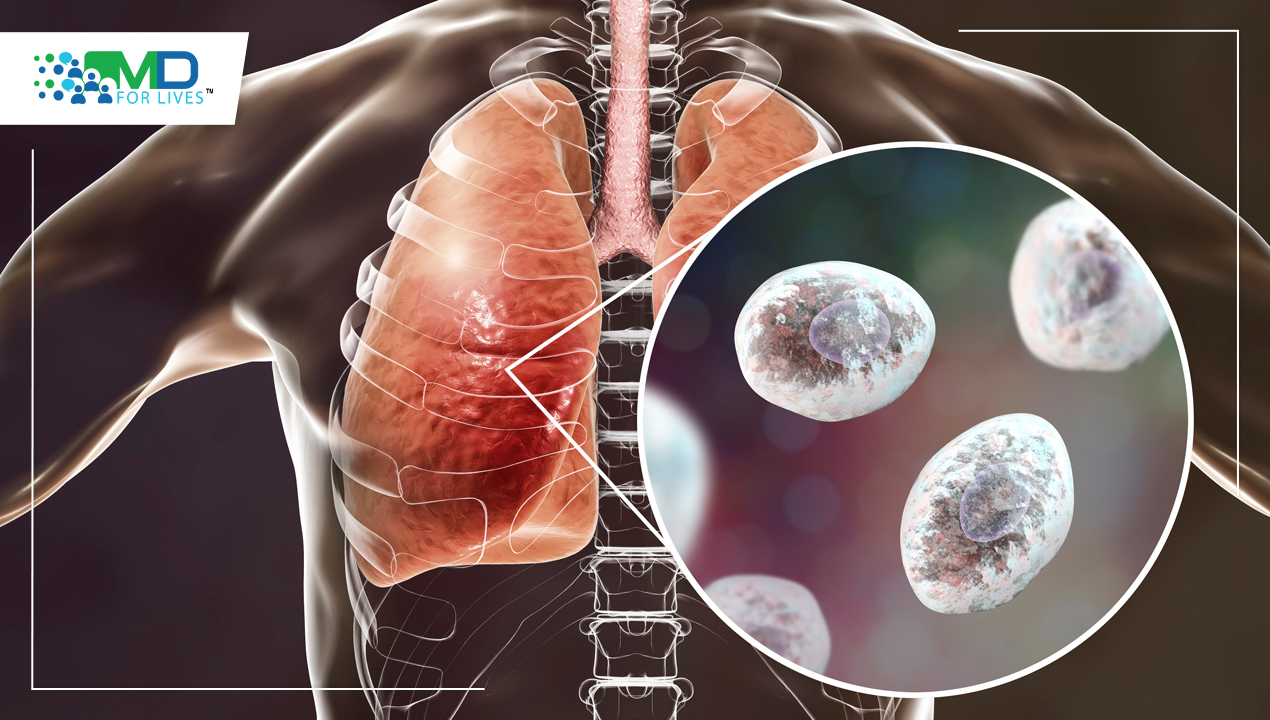 A study finds critical T cells for fungal pneumonia immunity