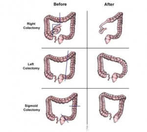 breakdown of standard colectomies for adenocarcinoma of the colon