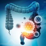 Bowel Cancer