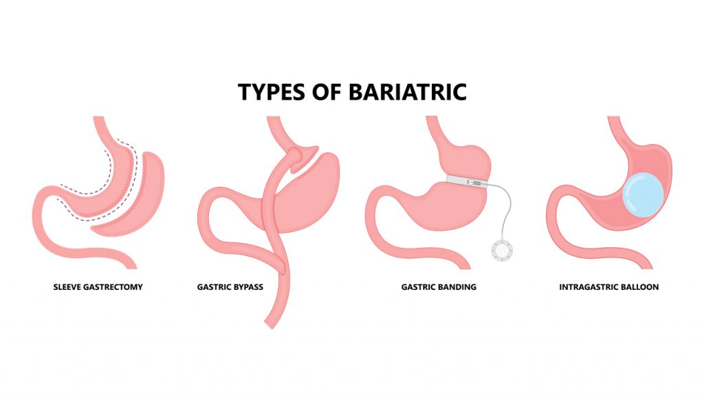 Types of Bariatric