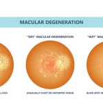 New Treatments for macular degeneration