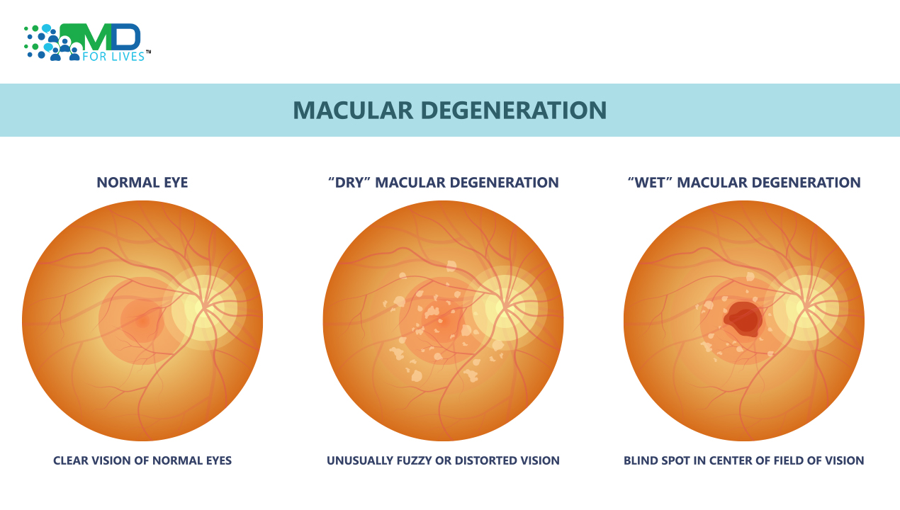 New Treatments for macular degeneration