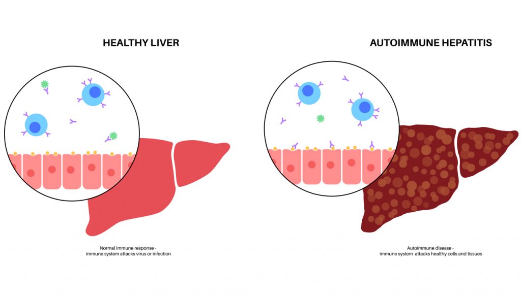 autoimmune hepatitis autoimmune hepatitis