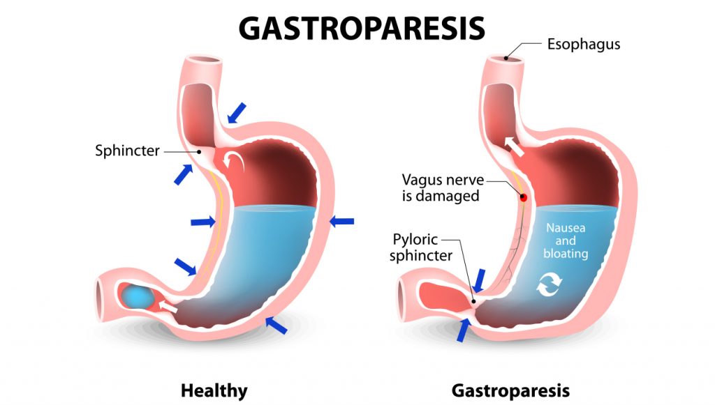 symptoms of a paralyzed stomach