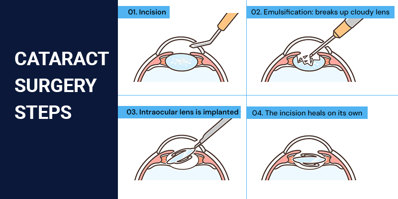 Step-by-step illustration of cataract surgery procedure with intraocular lens implantation