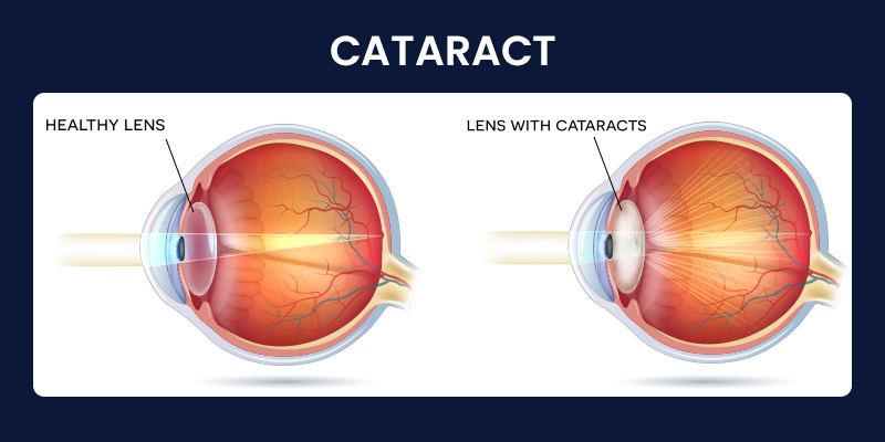 Eye anatomy diagram showing cataract formation in the natural lens