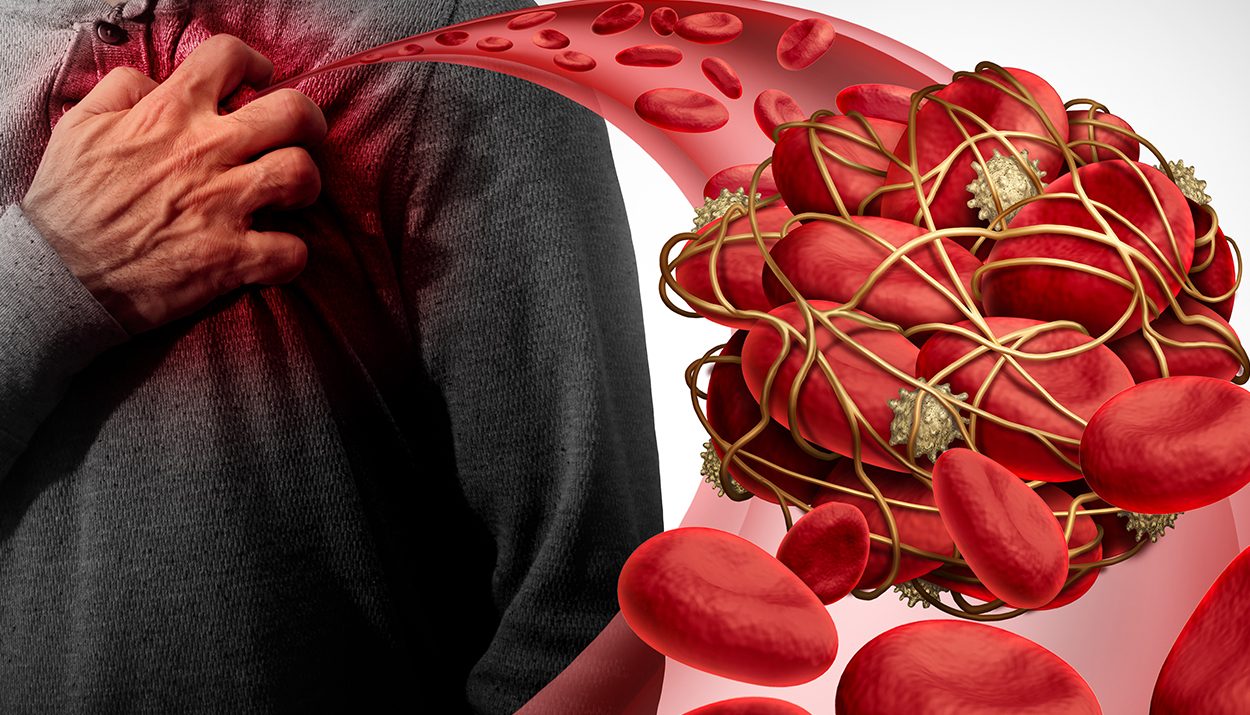 Thrombolytic Therapy