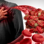 Thrombolytic Therapy