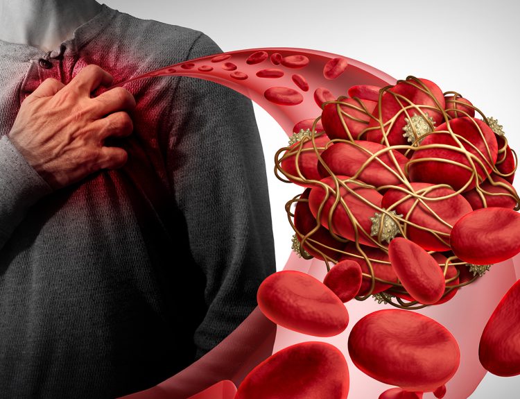 Thrombolytic Therapy