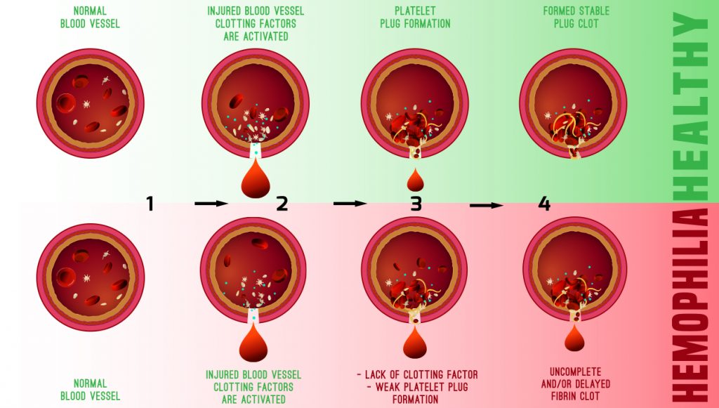 What causes Christmas Disease