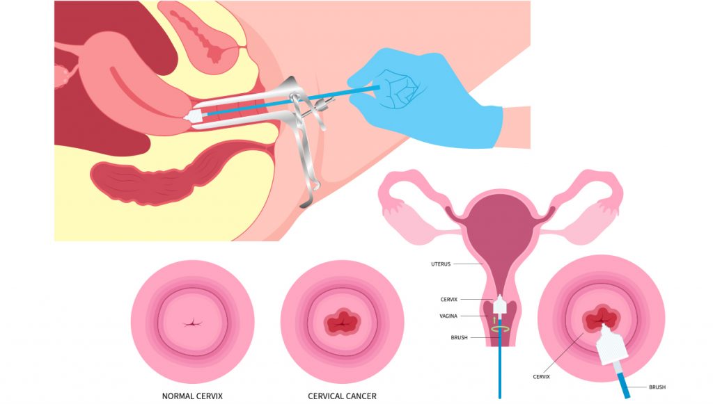 Pap smears