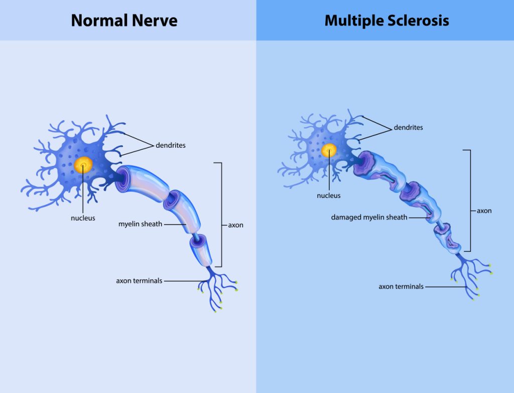 Multiple Sclerosis