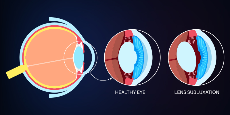 Diagram illustrating Ectopia Lentis with lens subluxation