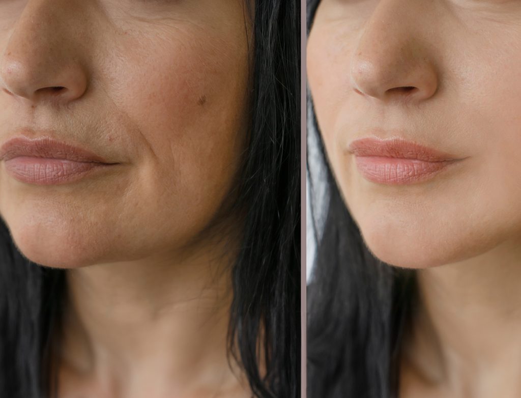 Perioral mound removal