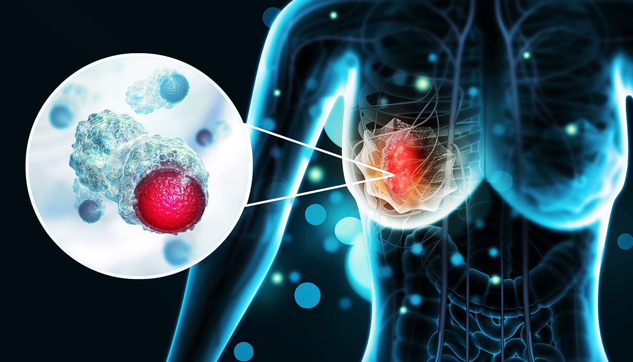 Chemicals Linked to Breast Cancer