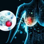 Chemicals Linked to Breast Cancer