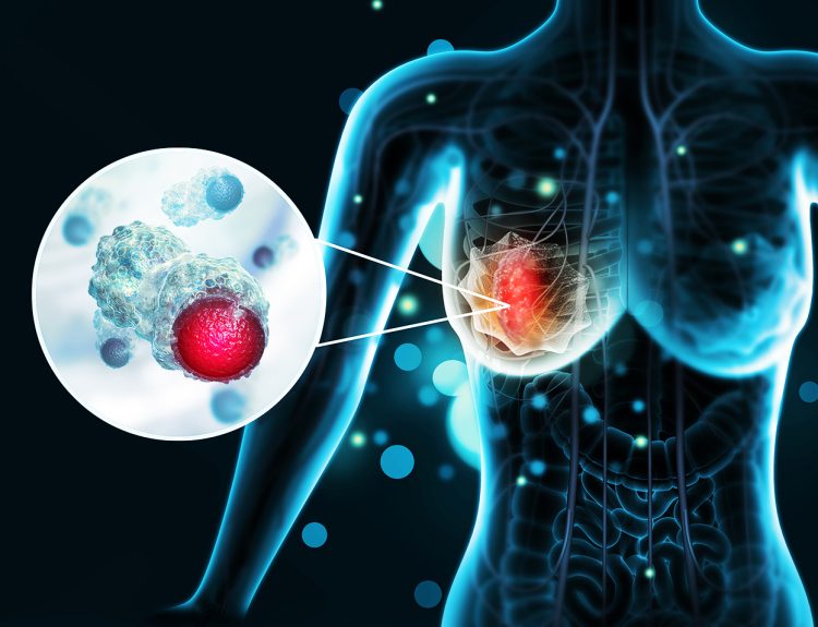Chemicals Linked to Breast Cancer