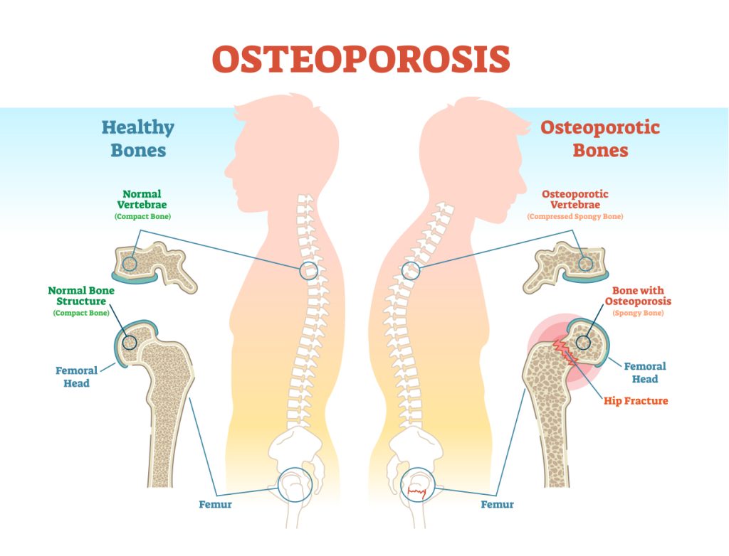 Osteoporosis Disease