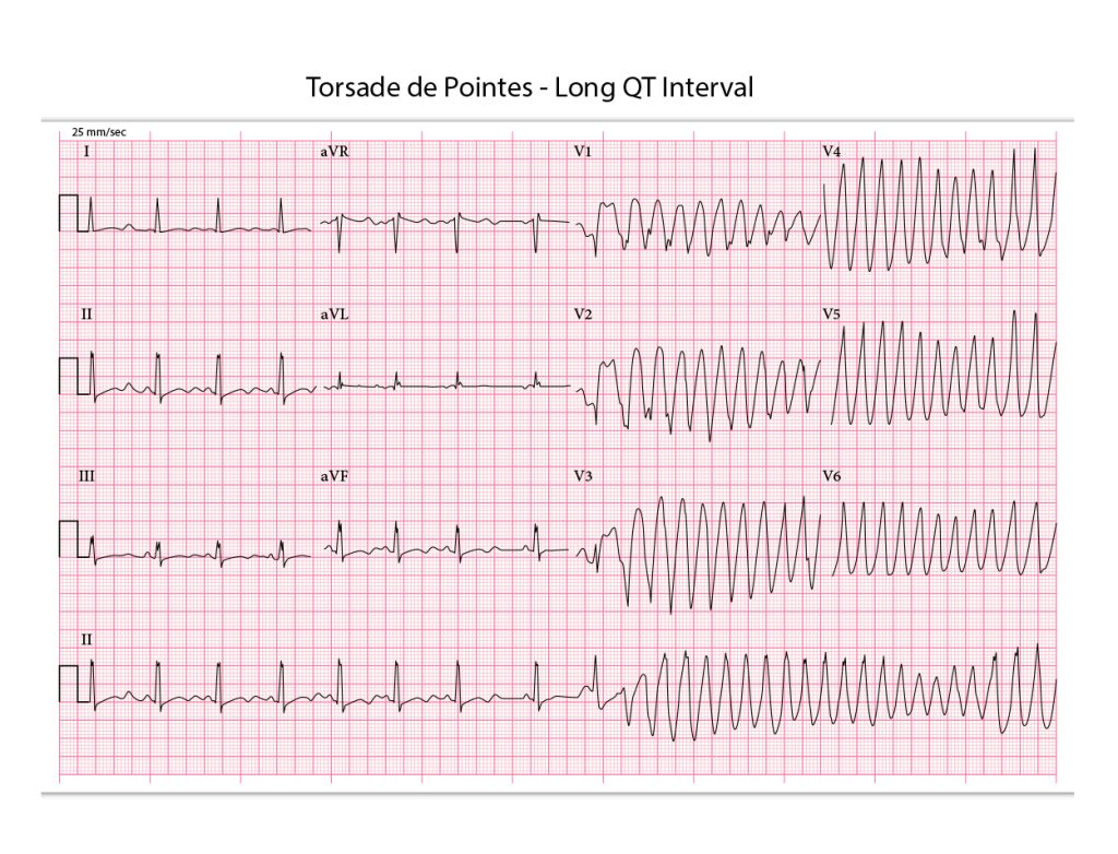 long qt syndrome symptoms