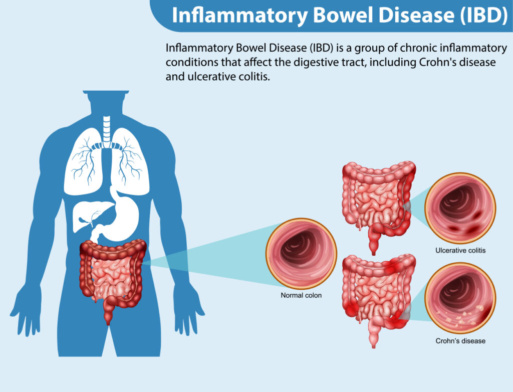 Inflammatory Bowel Disease