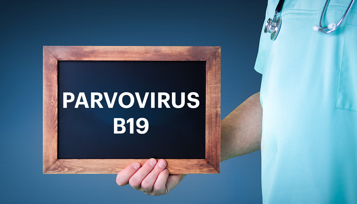 Parvovirus B19