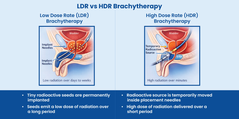 Comparison of low dose rate and high dose rate prostate brachytherapy