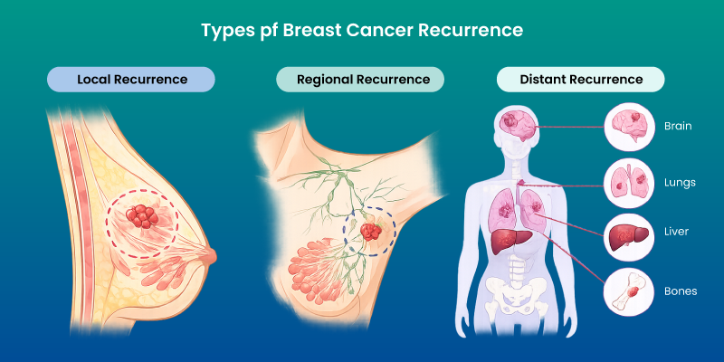 types of breast cancer recurrence local regional and distant spread diagram