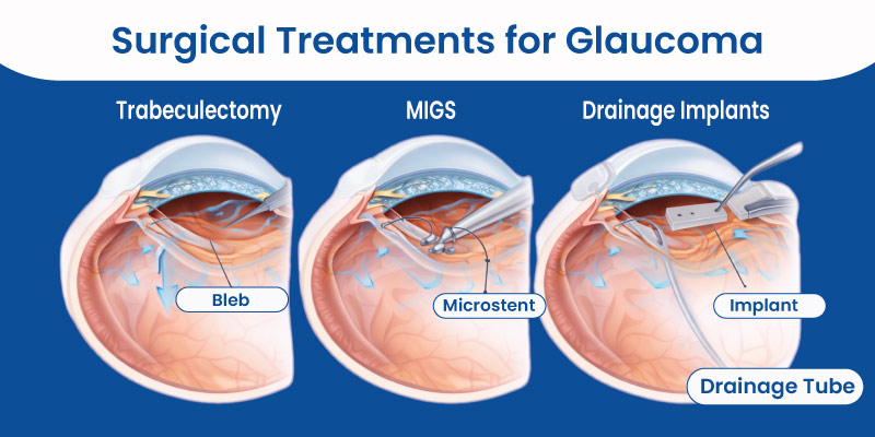 diagram showing types of glaucoma surgery