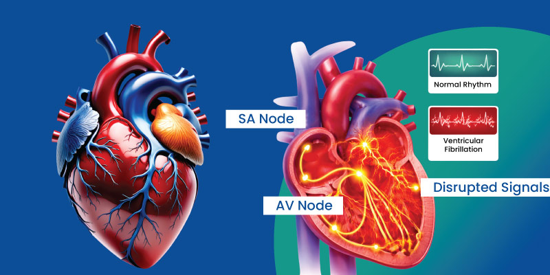 Diagram explaining sudden cardiac arrest in athletes due to heart rhythm disturbance