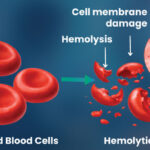 hemolytic anemia