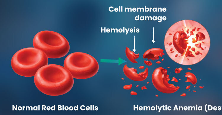 hemolytic anemia