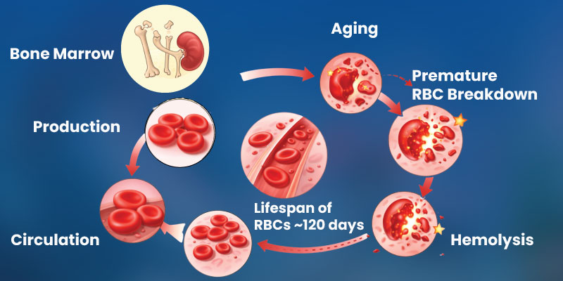 Illustration showing premature breakdown of red blood cells in hemolytic anemia