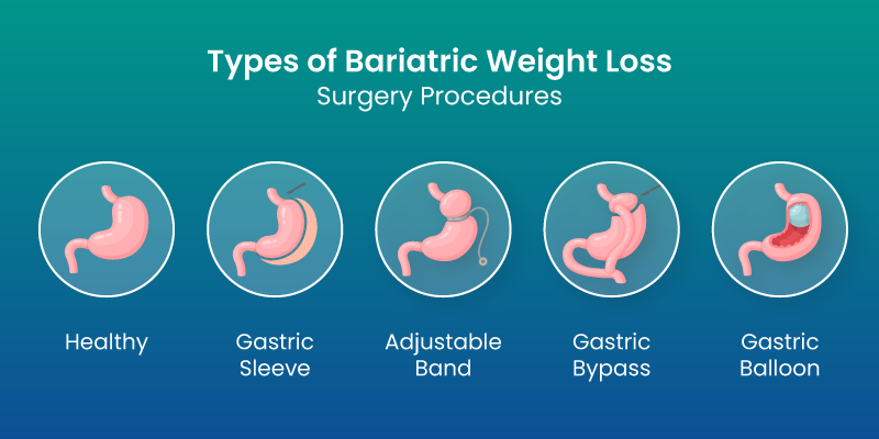 types of bariatric weight loss surgery procedures