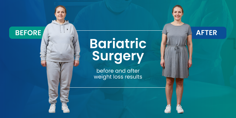 bariatric surgery before and after weight loss results