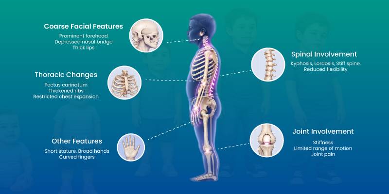 hurlers syndrome symptoms affecting skeletal and physical development