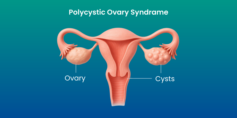 polycystic ovary syndrome hormonal imbalance illustration