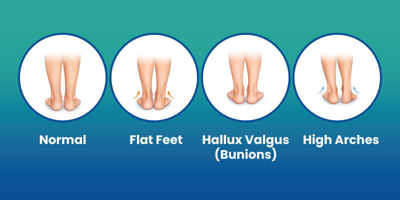 charcot marie tooth disease symptoms affecting feet and walking