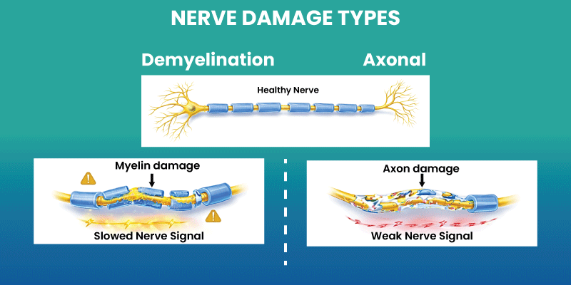 types of charcot marie tooth disease showing nerve damage differences
