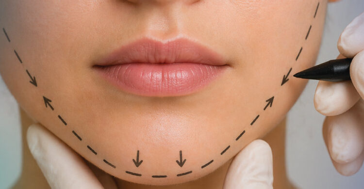 perioral mound liposuction