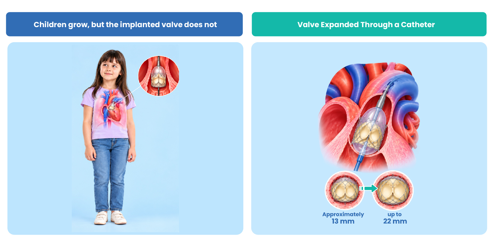 Illustration showing a pediatric pulmonary valve implanted in a young child, childhood growth, catheter-based valve expansion and continued cardiac follow-up.