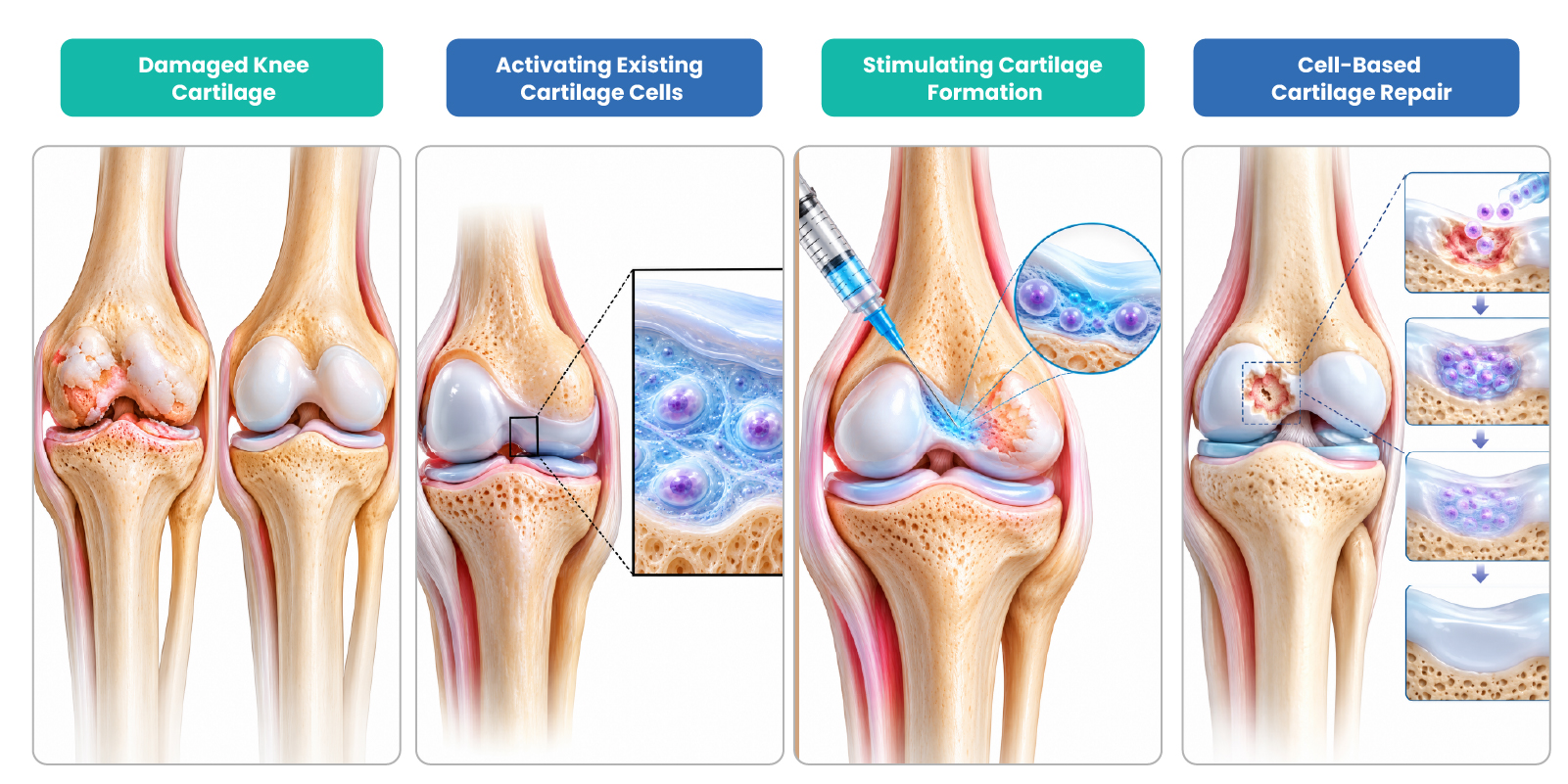 Illustration showing damaged knee cartilage and emerging research approaches including cartilage-cell activation, regenerative treatments and cell-based cartilage repair.