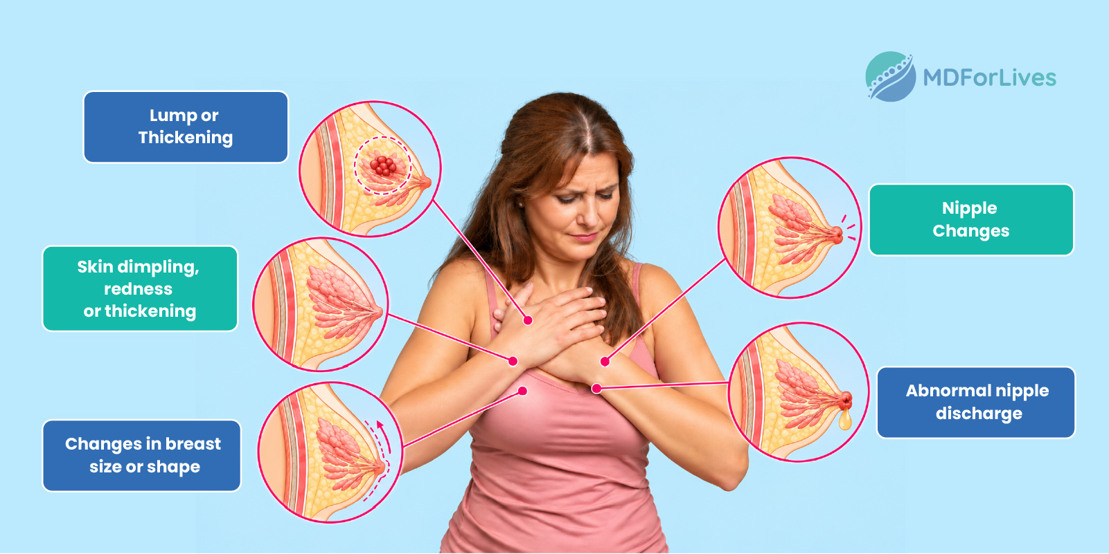 Signs of breast cancer other than a lump 